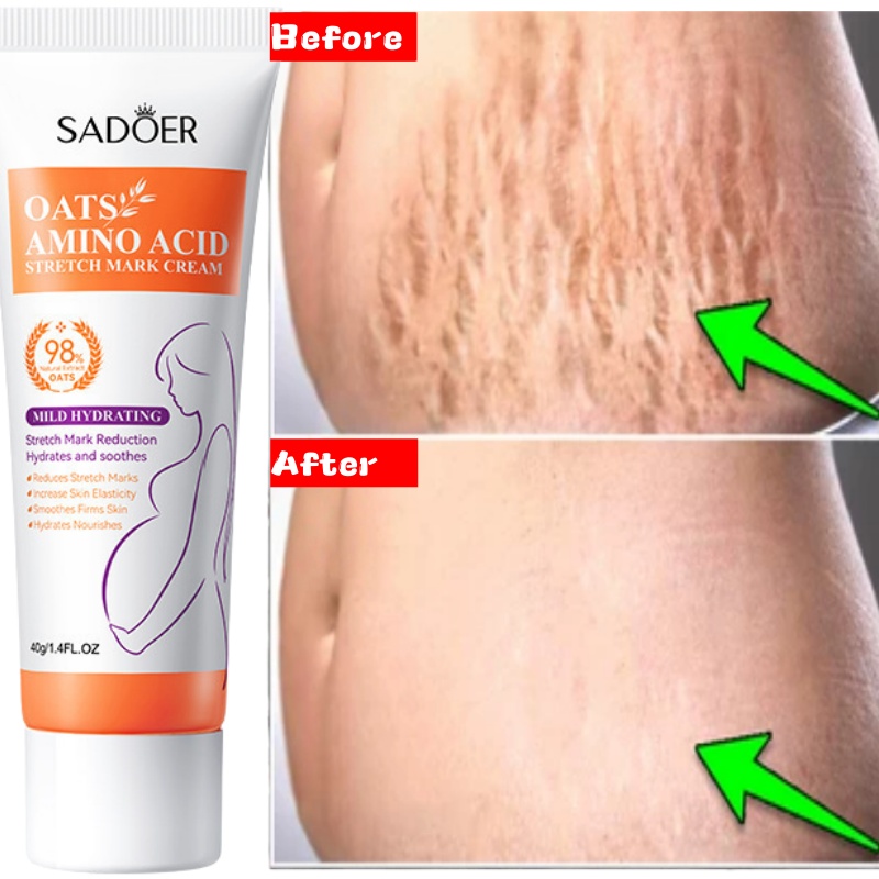 Skincare Oat - Stretch Marks Permanent Removal Cream Eliminate