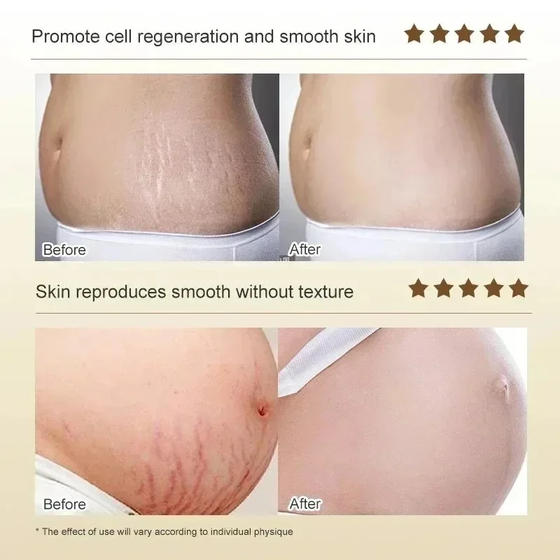 Stretch Marks Permanent Remova - огляд і ціна Skincare Oat